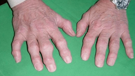 Maladies conjointes